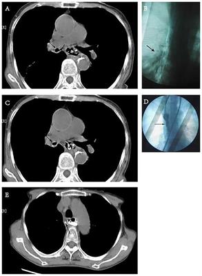 New improved incision-tubing approach for bronchoesophageal Fistula with mediastinal abscess after esophagectomy: A case report